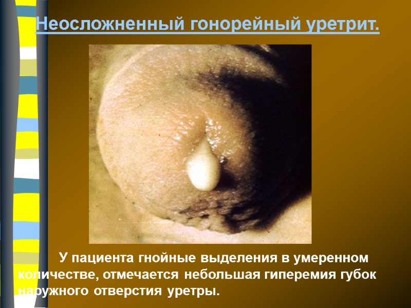 Неосложненный гонорейный уретрит.  У пациента гнойные выделения в умеренном количестве, отмечается небольшая гиперемия